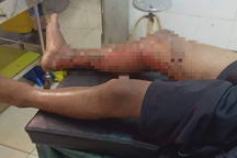 Khởi tố vụ án cháu bé 8 tuổi bị đốt bỏng hai chân