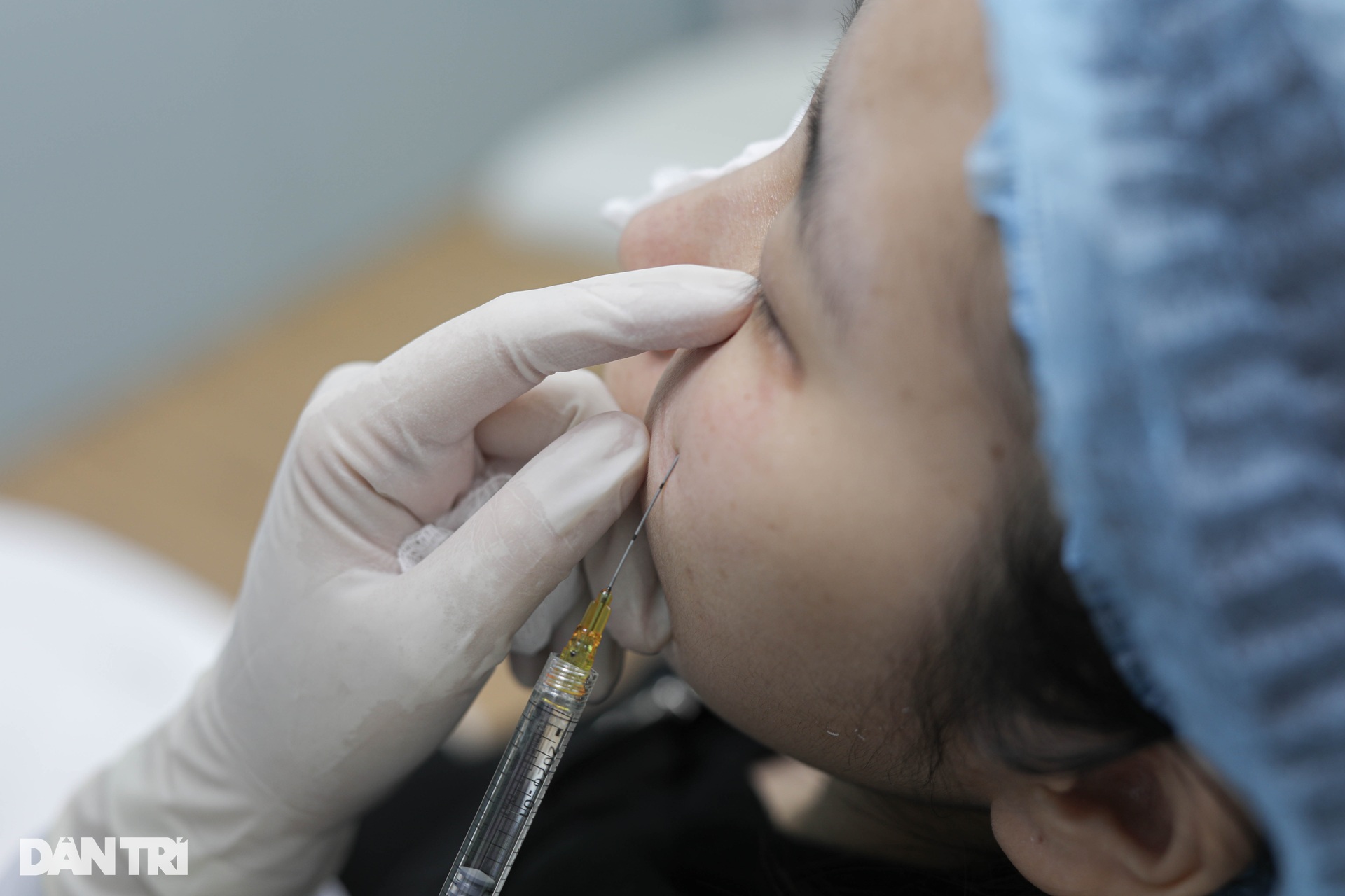 Gen Z chi gần 10 triệu để tiêm filler làm đầy hốc mắt - 10 Gen Z chi gần 10 triệu để tiêm filler làm đầy hốc mắt - 10