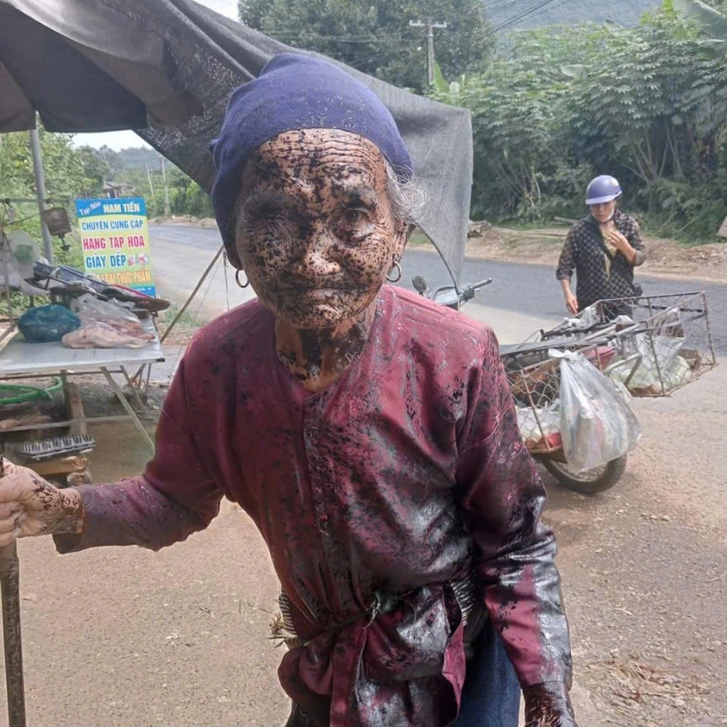 Thanh Hóa: Cụ bà bị nhũ tương nhựa đường dính đầy mặt sau sự cố thi công - 1 Thanh Hóa: Cụ bà bị nhũ tương nhựa đường dính đầy mặt sau sự cố thi công - 1
