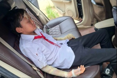 Vụ nổ bóng bay trong lễ khai giảng: Bóng bơm khí dễ phát nổ, gây bỏng rộng