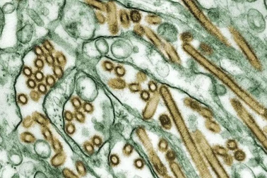 Căn bệnh đặc biệt nguy hiểm được WHO cảnh báo có triệu chứng như thế nào?