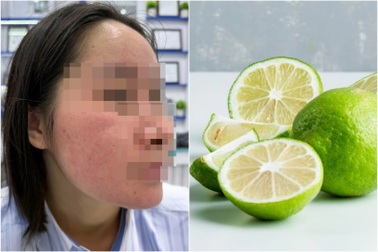 Bôi chanh lên mặt trị mụn theo hội nhóm Facebook, thiếu nữ mặt "nở hoa"