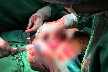 Bác sĩ dùng tay xoa bóp trực tiếp quả tim, cứu nữ bệnh nhân bị đâm