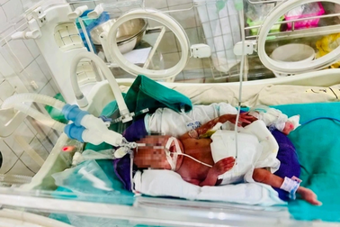 Bé sinh non 400g phát triển như thế nào sau một năm?