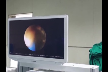 Cả nghìn viên sỏi lấp đầy ống mật bệnh nhân 64 tuổi