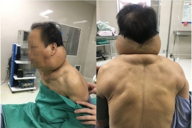 Người đàn ông bị biến dạng như người khổng lồ sau nhiều năm nghiện rượu