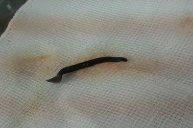  Gắp con đỉa dài 4,5 cm thập thò cửa mũi 