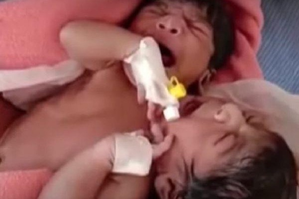 Cặp sinh đôi dính liền có 2 đầu 3 tay ra đời ở Ấn Độ - 1 Cặp sinh đôi dính liền có 2 đầu 3 tay ra đời ở Ấn Độ - 1