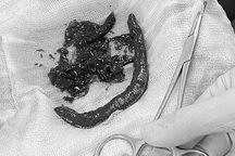 Hy hữu đỉa chui vào “cậu nhỏ” và hút máu nội tạng