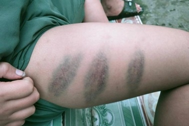 Người phụ nữ "tố" chồng cũ đánh con bầm tím thân thể