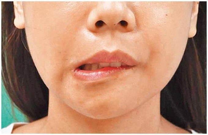 Hứng lên nhảy múa một chút, người phụ nữ ngất xỉu nhập viện trong tình trạng xuất huyết não nặng rồi tử vong - Ảnh 2. Hứng lên nhảy múa một chút, người phụ nữ ngất xỉu nhập viện trong tình trạng xuất huyết não nặng rồi tử vong - Ảnh 2.