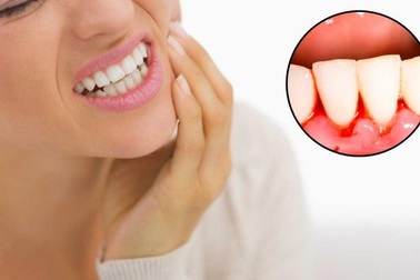 Dung dịch nha khoa Nutridentiz - Giải pháp vàng cho người bị chảy máu chân răng