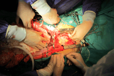 Thêm 4 người suy tạng được cứu sống từ nguồn tạng hiến