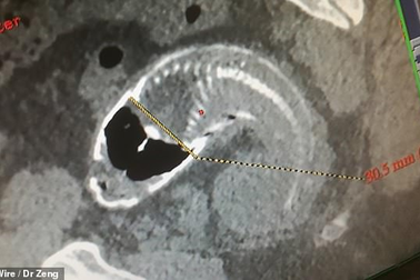 Kinh hoàng phát hiện “nguyên con cá rô phi trong bụng”