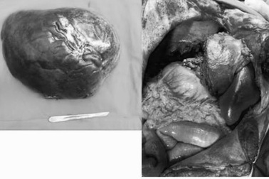 Cắt khối u 5kg “ngụ” trong gan bệnh nhân