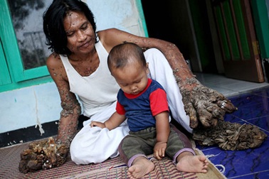 Hình ảnh mới nhất về anh chàng “người cây”