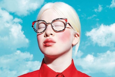 Cô bé bạch tạng bị cha mẹ bỏ rơi thành người mẫu nổi tiếng