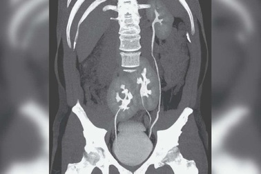 Phát hiện có tới 3… quả thận khi đi khám đau lưng