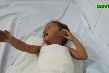 Bé 2 tuổi ngã vào nồi cám lợn bị bỏng nặng