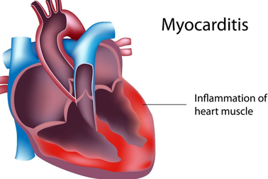 Hiểu đúng về căn bệnh viêm cơ tim khiến hai người Hà Nội tử vong