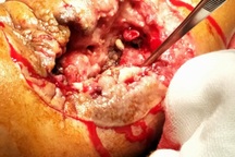 Đắp thuốc nam, hàng trăm ấu trùng ký sinh trên vết thương