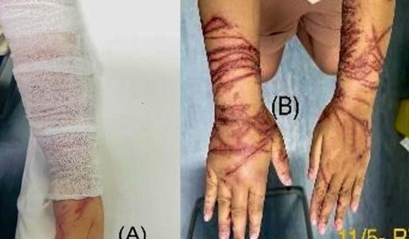 Vòng tay ôm sứa biển trong suốt, bé gái bị bỏng rát chằng chịt 2 cẳng tay - 2