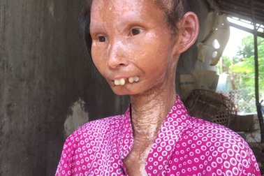 Chuyên gia nói gì về người phụ nữ xinh đẹp 34 tuổi thành bà lão nặng 24 kg