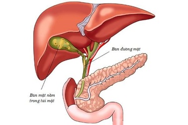 Sỏi bùn túi mật dễ gây viêm và hoại tử túi mật rất nguy hiểm