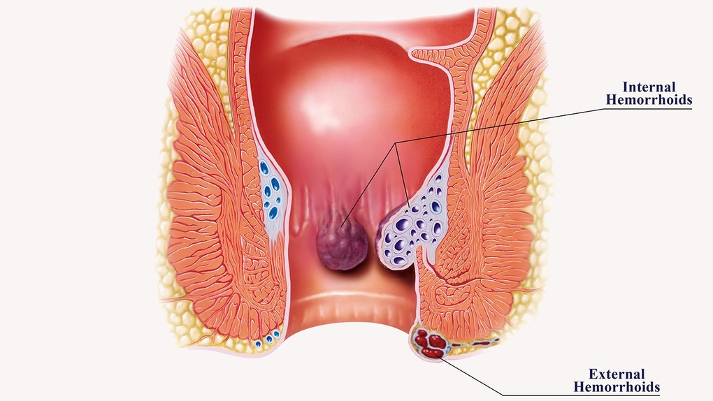 Bệnh Trĩ Có Liên Quan Đến Đại Tràng Không? Khám Phá Mối Liên Hệ và Giải Pháp Hiệu Quả