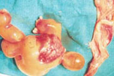 Bào thai trong cơ thể em bé 7 ngày tuổi