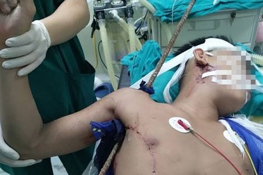 Tránh gạch rơi vào đầu, thanh niên bị thanh sắt đâm xuyên từ nách lên vai