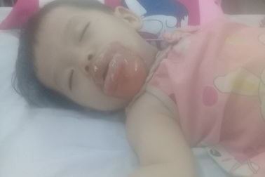 Bé gái 18 tháng tuổi bị bỏng nặng ở nhà trẻ