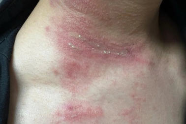 Kiến ba khoang "tấn công", xử lý tổn thương như thế nào?