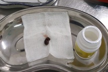 Con đỉa sống 3 tuần trong mũi người đàn ông