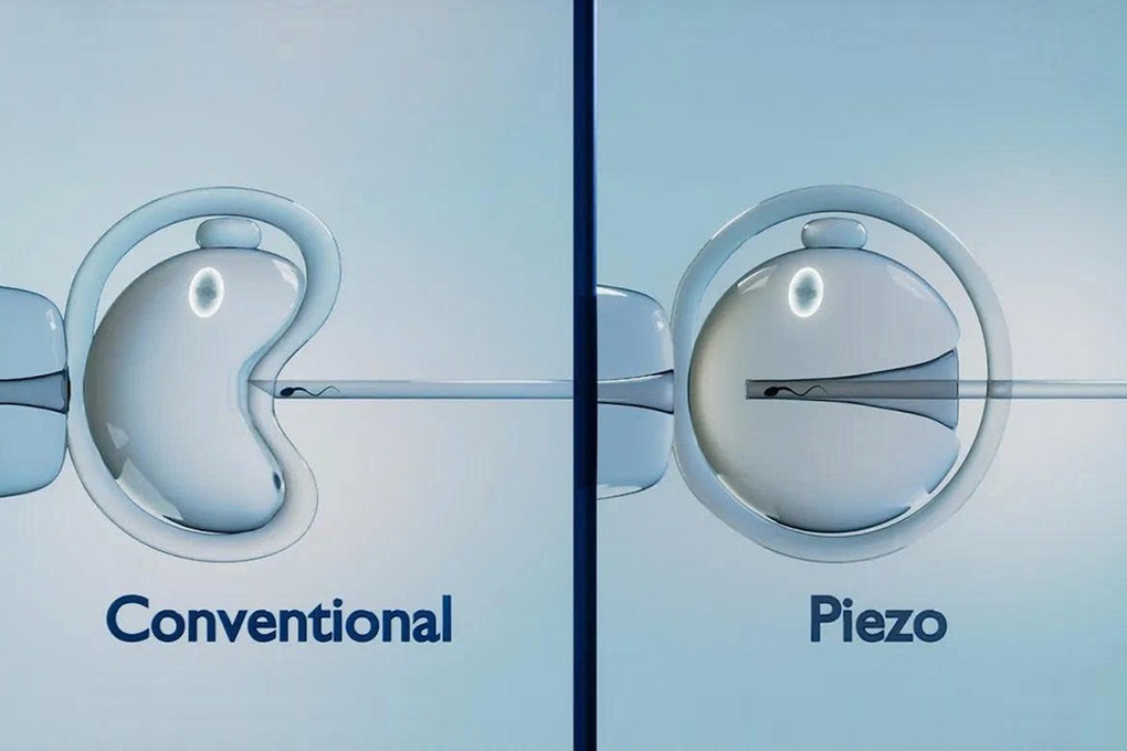 PIEZO ICSI: Công nghệ tạo phôi tiên tiến, nâng cao tỷ lệ thành công trong IVF - 2 PIEZO ICSI: Công nghệ tạo phôi tiên tiến, nâng cao tỷ lệ thành công trong IVF - 2