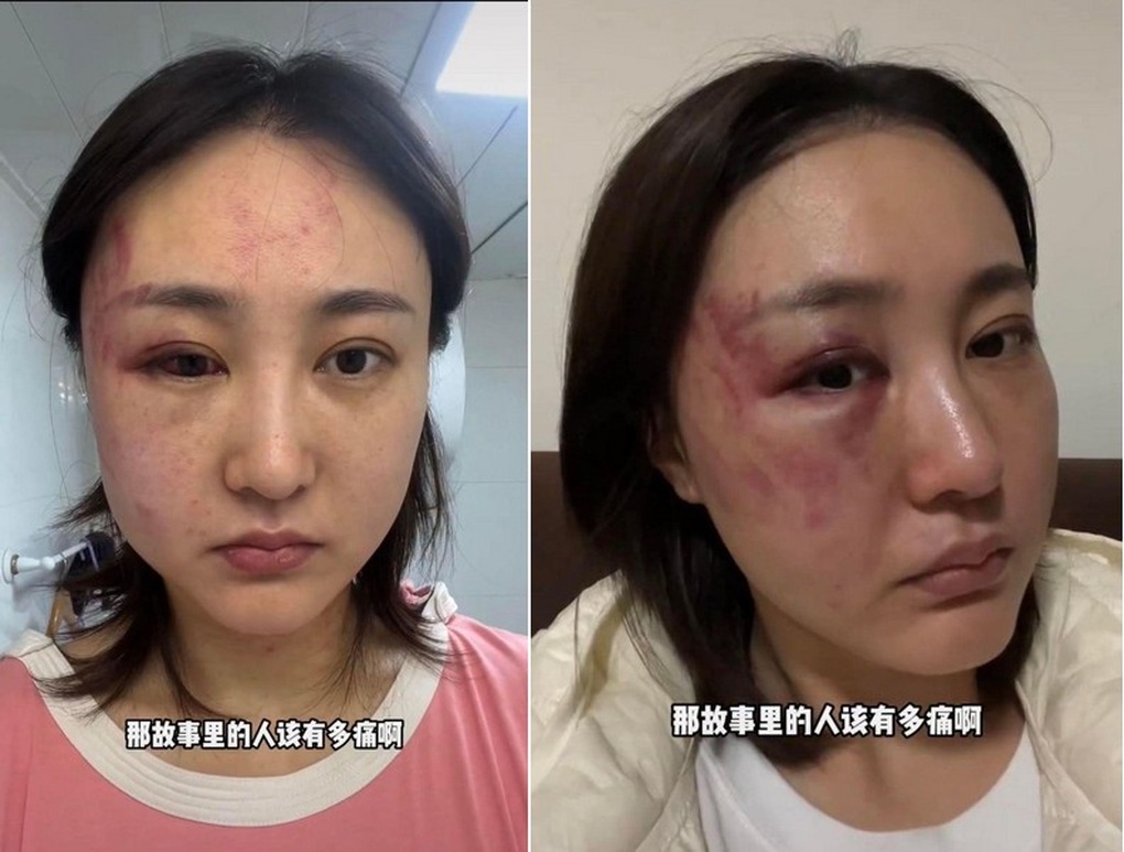 Gương mặt với nhiều vết thương tích sau khi Xu Dabao bị chồng bạo hành (Ảnh: Douyin). Gương mặt với nhiều vết thương tích sau khi Xu Dabao bị chồng bạo hành (Ảnh: Douyin).