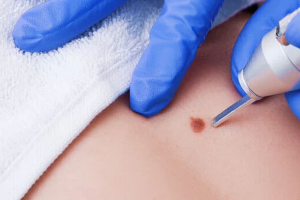 Dấu hiệu nhận biết nốt ruồi ung thư so với nốt ruồi thường - 1