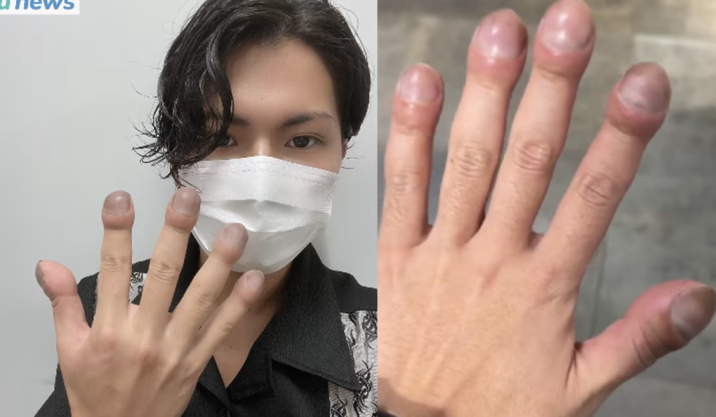 Nhà tạo mẫu tóc nổi khắp Nhật Bản vì ngón tay sưng to lạ lùng - 1 Nhà tạo mẫu tóc nổi khắp Nhật Bản vì ngón tay sưng to lạ lùng - 1