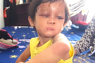 Bé gái 4 tuổi nghi bị cha nuôi bạo hành