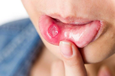 Phân biệt ung thư khoang miệng và nhiệt miệng như thế nào?