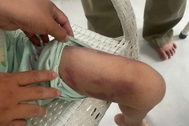 Bắt giam người mẹ và nhân tình bạo hành bé gái 9 tuổi ở TPHCM