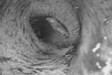 Lấy ổ ấu trùng ruồi trong tai một bệnh nhân