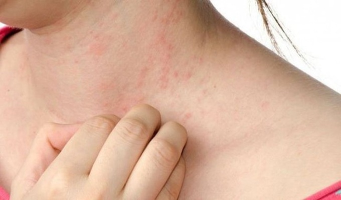 Hai vị trí trên cơ thể bị "ngứa", 80% là do bệnh gan, cảnh báo 3 loại thực phẩm gây hại cho gan - Ảnh 4. Hai vị trí trên cơ thể bị "ngứa", 80% là do bệnh gan, cảnh báo 3 loại thực phẩm gây hại cho gan - Ảnh 4.