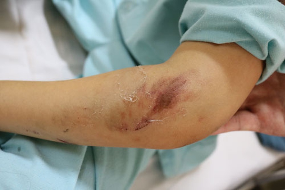 Vướng áo chống nắng, bé gái 7 tuổi bị cuốn vào bánh xe máy - 2