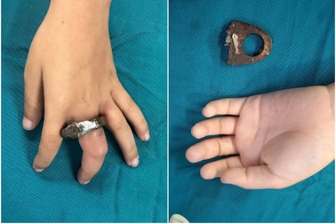 Hà Nội: Gia đình cưa cổng giải cứu bé trai kẹt tay trong vòng khóa