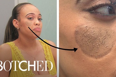 Thảm họa phẫu thuật thẩm mỹ: Lấy da vùng kín ghép lên mặt và cái kết "đắng"