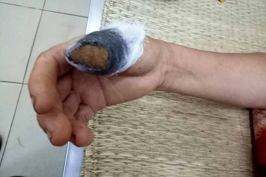 Hái nắm mồng tơi, bị hàng xóm cắn đứt lìa ngón tay