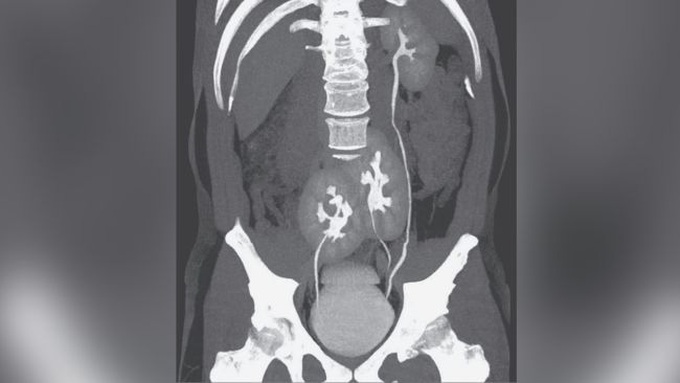Bị đau lưng, người đàn ông đi khám mới biết mình có tới 3 quả thận - Ảnh 1.