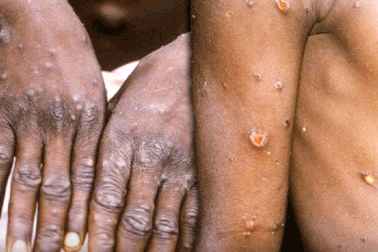 Mỹ xác nhận trường hợp tử vong đầu tiên do đậu mùa khỉ