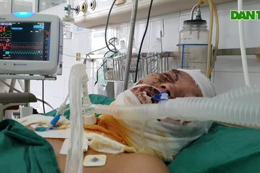 Bỏng điện cao thế chàng trai trẻ nguy kịch tính mạng